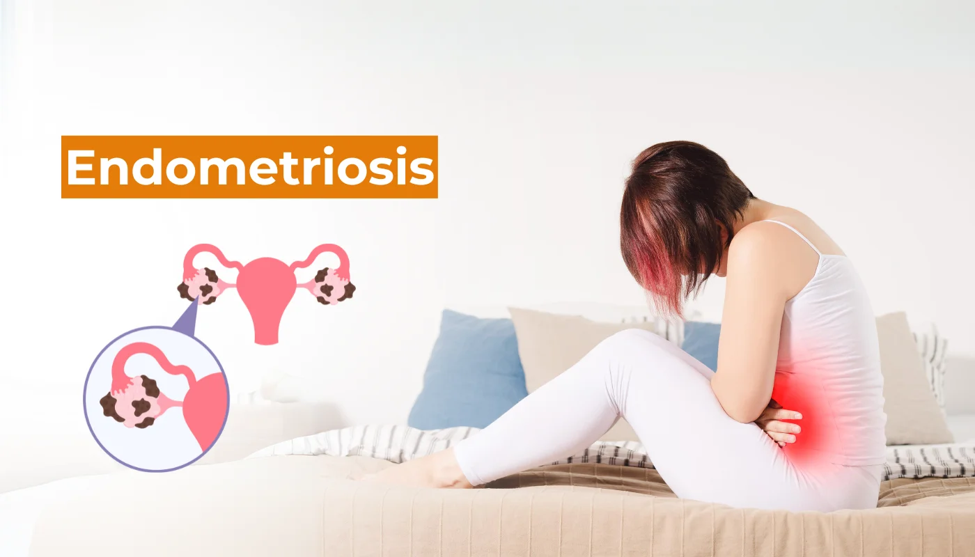 Endometriosis medical and surgical care by Dr. Prithivi Perum, Manikonda, Hyderabad